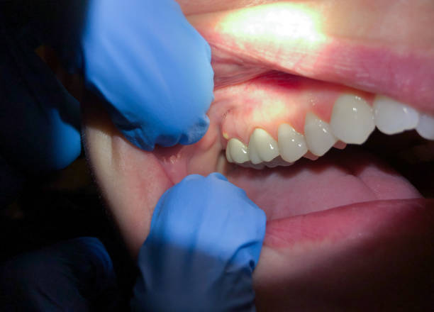 Best Emergency Tooth Extraction in Lonville, GA