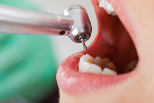 Best Emergency Root Canal Treatment in Lonville, GA